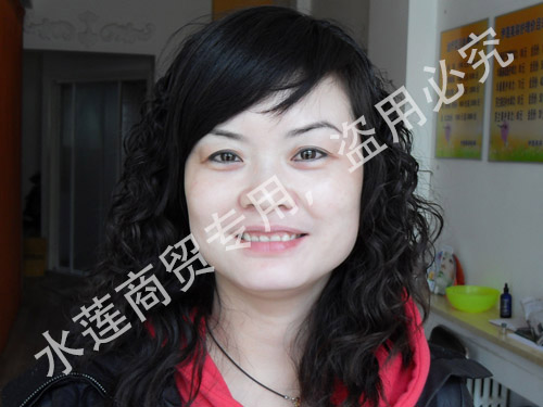雀斑治療后