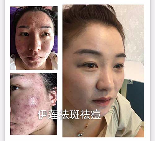 嚴(yán)重雀斑治療前后對(duì)比