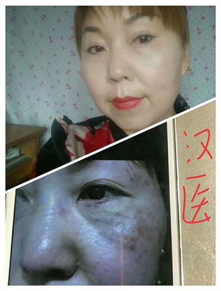 祛斑前后對(duì)比